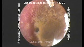 Ear wax removal Golden earwax fungus dry sheet cleaning 20241121 [upl. by Lynnea617]