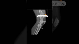 Osteochondroma  sessile xray knee shortfeed [upl. by Ennaillek]