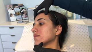 Dermapen Skin Needling for Acne amp Scarring [upl. by Atirihs]