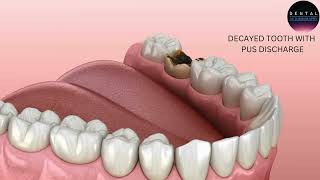 Root Canal Treatment Save Your Tooth and Stop Infection [upl. by Euqinaj]