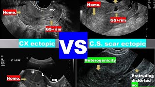 lecture 9 ultrasound of bleeding in early pregnancy 2 [upl. by Hux192]