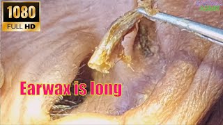 Earwax is long and wet I keep pulling and it still doesnt go away [upl. by Shaff]