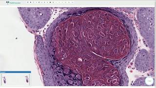 Molluscum Contagiosum  Histopathology [upl. by Colby]