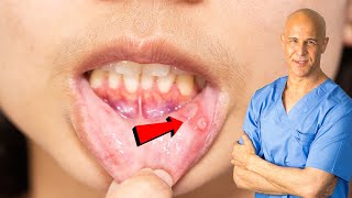 How I Quickly Healed My Canker Sore  Dr Mandell [upl. by Delorenzo]