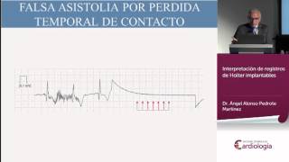 Interpretación de registros de Holter implantables [upl. by Cheria]