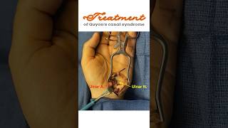 Treatment of Guyon’s canal syndrome Ulnar tunnel syndrome shorts [upl. by Maddocks]