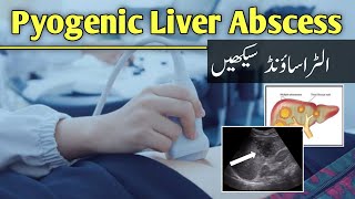 Pyogenic Liver Abscess in Ultrasound by Dr Ali Waqar [upl. by Jennilee]