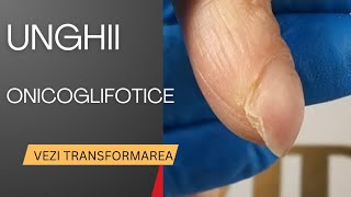 Unghii Onicoglifotice Bombate Lovite Transformare [upl. by Shelah]