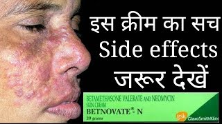 The Shoking Truth Of Betnovate N Cream Betnovate n cream Review and Side effects [upl. by Airrehs]