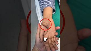 Strange Hand Disease 😨 [upl. by Tnarb]