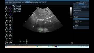 IQ 276 TFAST LUNG MASS ULTRASOUND ECHOPAC ANALYSIS 3 4 [upl. by Necila633]