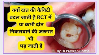 कैसे दांत की CAVITY पहुंच जाती है रूट कैनालRoot Canalनिकालने Extractionकी स्टेज तक teethcavity [upl. by Conney529]