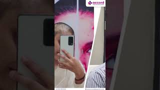 Success Story Alopecia Areata Treatment  Patient Testimonial  Dr Sonali Gupta [upl. by Giovanna693]