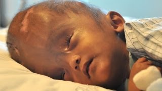 Swollen Head Baby Leaves Hospital After Successful Surgery [upl. by Nwahsad]