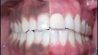 Remove dark gums with WATER [upl. by Enyalaj491]