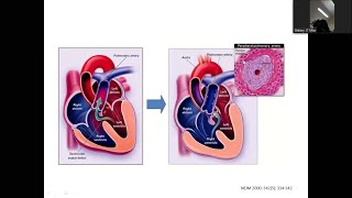 Eisenmenger Syndrome by Dr Abdullah Shahriar sir [upl. by Yblocaj280]