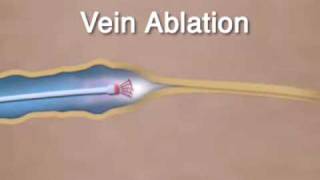 Varicose Vein Ablation amp Closure [upl. by Kinemod525]