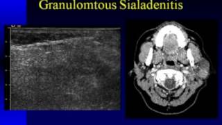 Ultrasound Imaging of the Salivary Glands [upl. by Guarino]