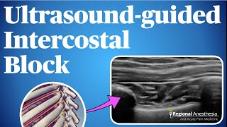 UltrasoundGuided Intercostal Nerve Block [upl. by Kcirtemed]