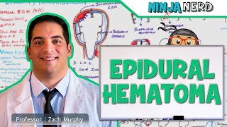 Epidural Hematoma  Anatomy Etiology Pathophysiology Clinical Features Treatment [upl. by Sine]