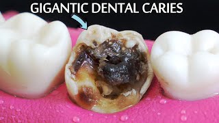 INCREDIBLY SATISFYING Restoration Of Massive Tooth Decay  Root Canal And Crown Process [upl. by Kensell]