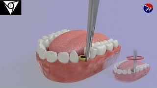 M1 Atraumatic ankylosed root extraction using pre elevator 1 [upl. by Jeuz]