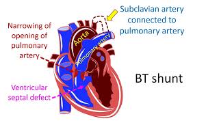 What is Blalock  Taussig BT shunt operation [upl. by Gaves]