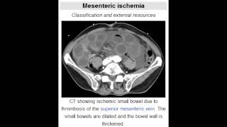 Acute Mesenteric Ischemia Adult Intussusception Infants [upl. by Atinas]