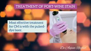 Port Wine Stain Causes Syndromes Symptoms Diagnosis and Treatment  Facial Birth Marks [upl. by Anitteb]