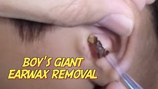 Boys Giant Earwax Removal [upl. by Walsh955]