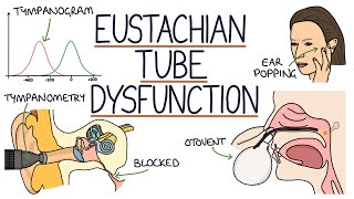 Understanding Eustachian Tube Dysfunction [upl. by Slifka305]