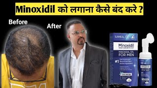 How to stop minoxidil aftre hair regrowth step by step Minoxidil ko lagana kaise band kare [upl. by Carlen]