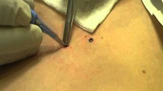 Microdermal Dermal Anchor Removal at MediZen Cosmetic Clinic Birmingham UK [upl. by Canon]