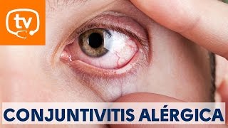 Claves sobre la conjuntivitis alérgica [upl. by Arriek375]