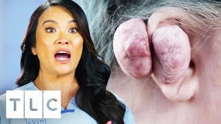 Dr Lee Removes 14 Oz Keloid From Womans Ear  Dr Pimple Popper [upl. by Ainesey]