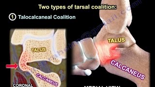 Tarsal Coalition  Everything You Need To Know  Dr Nabil Ebraheim [upl. by Newton33]