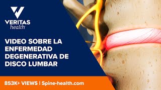 Video sobre la enfermedad degenerativa de disco lumbar [upl. by Nimoynib]