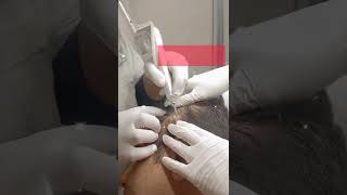 Seborrheic keratosis treatment  Laser Treat [upl. by Tutto]