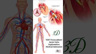 TAVI Transcatheter Aortic Valve Implantation  medical animation 3d short  BiologywithAliya [upl. by Doralin]