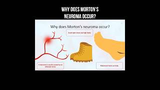 Why does Mortons neuroma occur morton neuroma inflammation nervepainrelief [upl. by Greabe508]