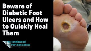 Beware of Diabetic Foot Ulcers and How to Quickly Heal Them [upl. by Nappie]