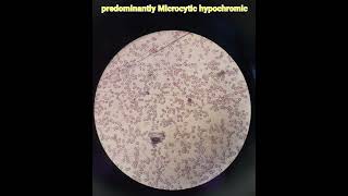 Hematologyanaemiamicrocytic hypochromicpathologymedical [upl. by Pomona]