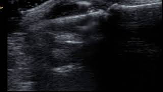 Ultrasound guided CS injection of the PIP joint in RhA Dorsal longitudinal scanOut of Plane [upl. by Ellierim]