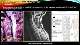 Traumatisme du rachis cervical 🤩 meilleure explication 🤩 par Pr Atia [upl. by Langdon234]