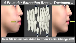 Changes in Face After 4 1st Premolars Extraction amp Braces Treatment Best HD Animation  Dr Ram MDS [upl. by Charteris806]