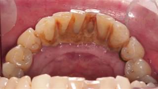 Before and After Scale and Polish  Dental Hygienist Telford [upl. by Gerrie551]