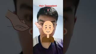 Hair transplant stickman animation [upl. by Haronid]