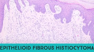 Epithelioid fibrous histiocytoma benign ALK1 skin tumor ALK gene fusion pathology dermpath [upl. by Worthy877]