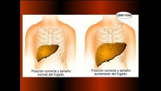 Salud ¿Qué es la hepatomegalia [upl. by Eelirrem]