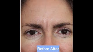 Anti wrinkle injections for Frown [upl. by Deegan]